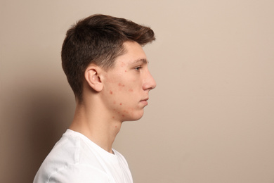 Photo of Teen guy with acne problem on beige background. Space for text