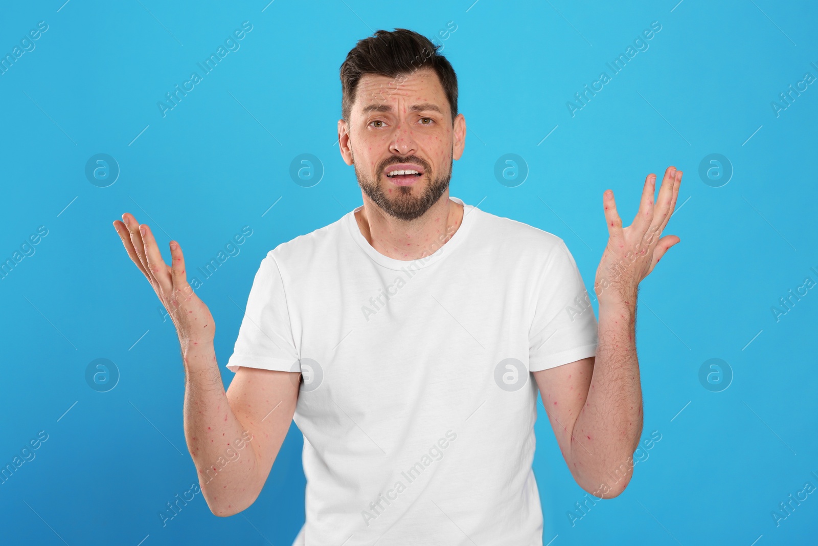 Photo of Man with rash suffering from monkeypox virus on light blue background