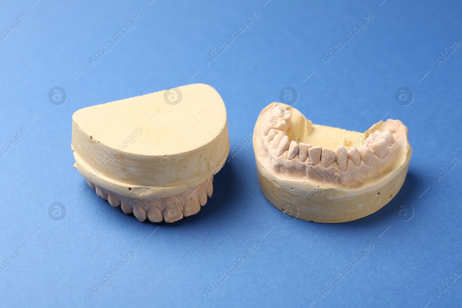 Photo of Dental model with gums on blue background. Cast of teeth