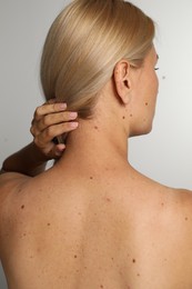 Woman with birthmarks on light grey background, back view