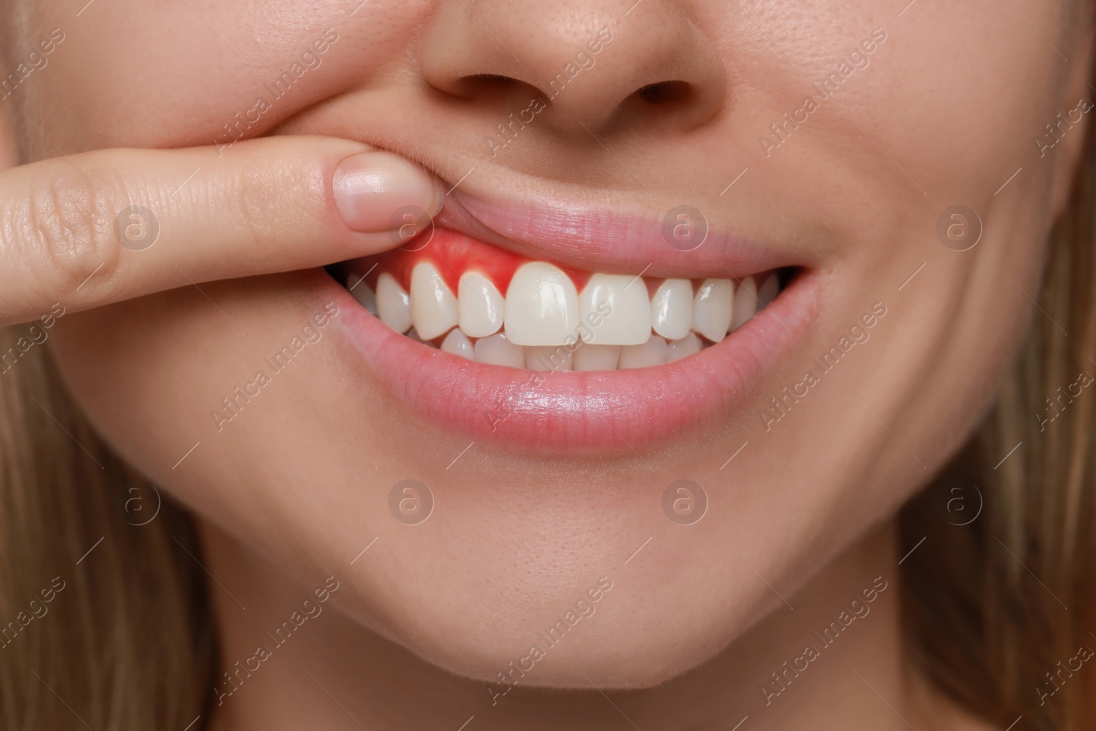 Image of Woman showing inflamed gum, closeup. Oral cavity health