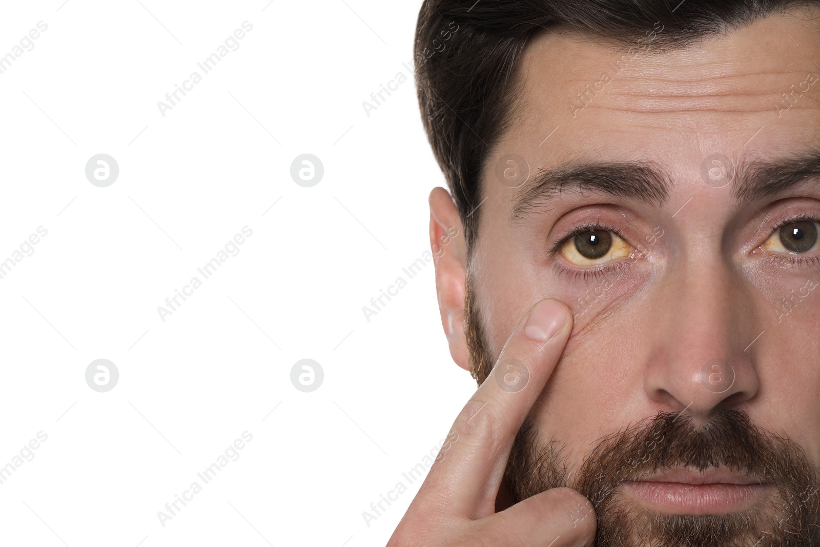 Photo of Man with yellow eyes on white background, closeup. Symptom of hepatitis