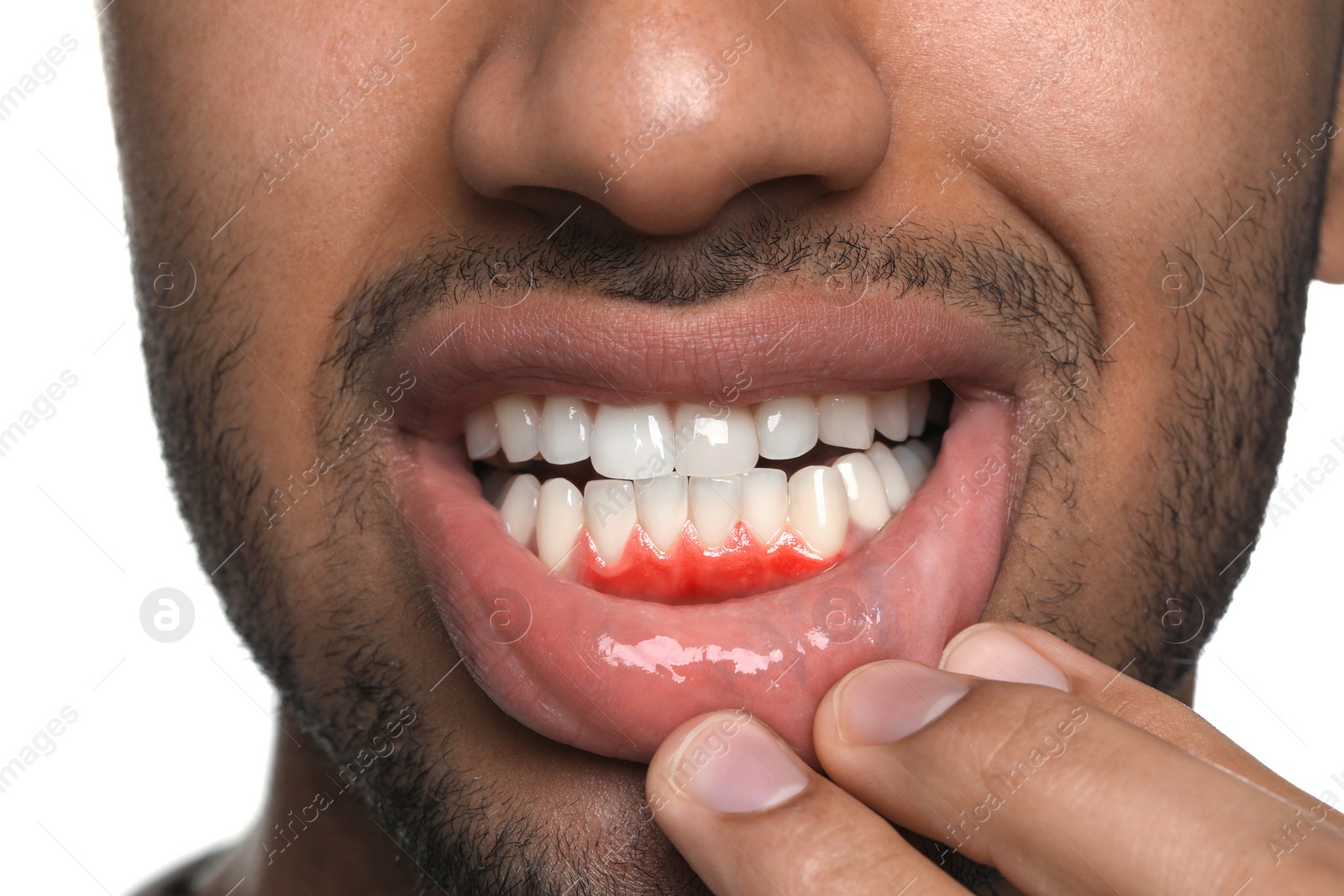 Image of Man showing inflamed gum on white background, closeup