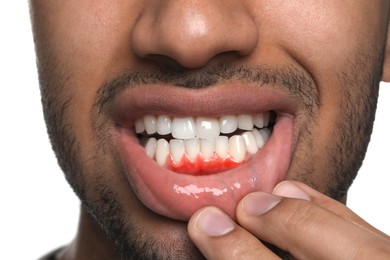 Image of Man showing inflamed gum on white background, closeup