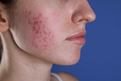 Photo of Young woman with acne problem on blue background, closeup