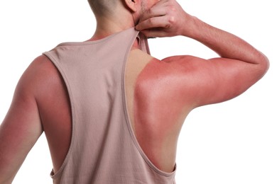 Man with sunburned skin on white background, closeup