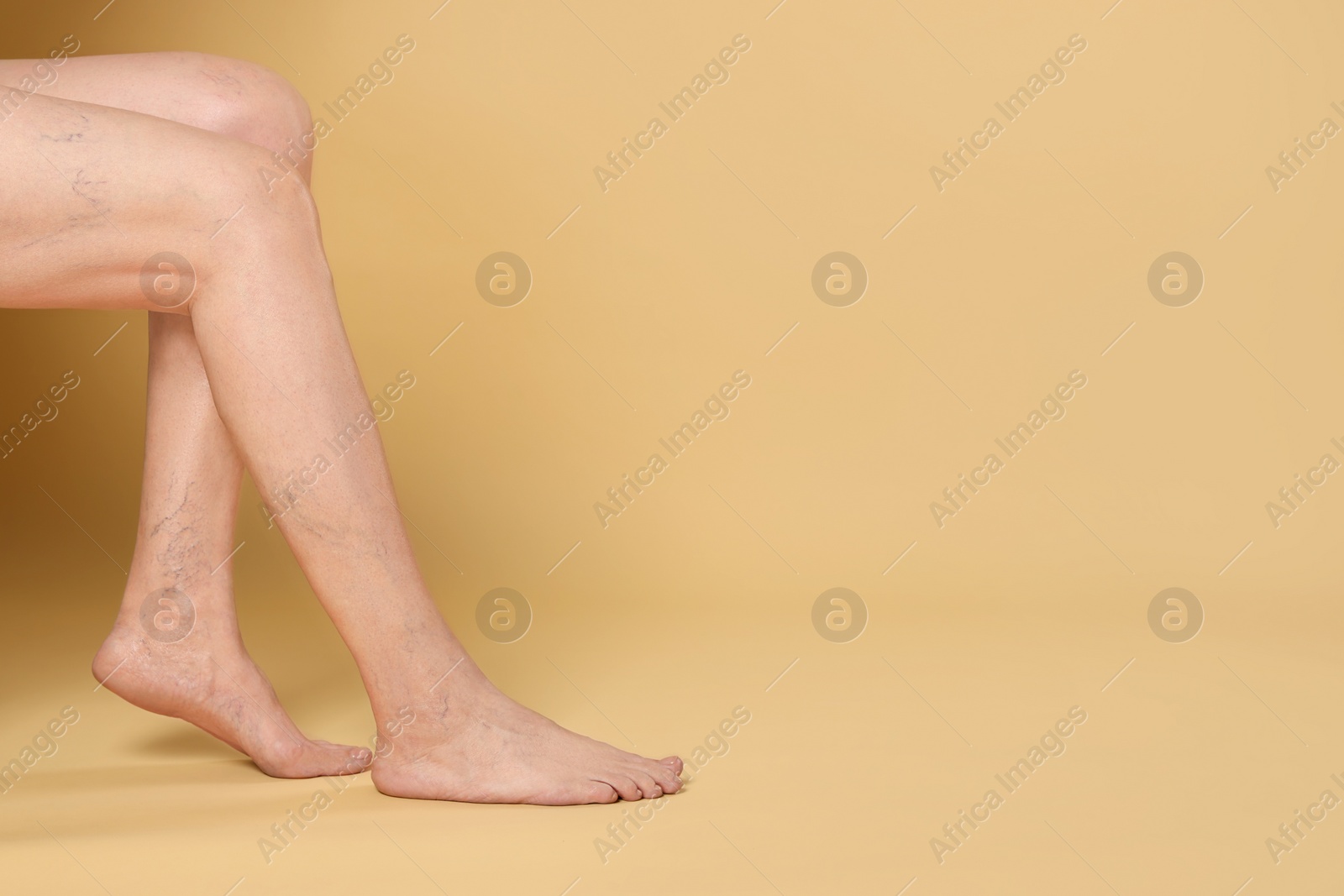 Photo of Closeup view of woman with varicose veins on yellow background. Space for text