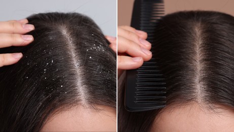 Image of Woman showing hair before and after dandruff treatment, collage