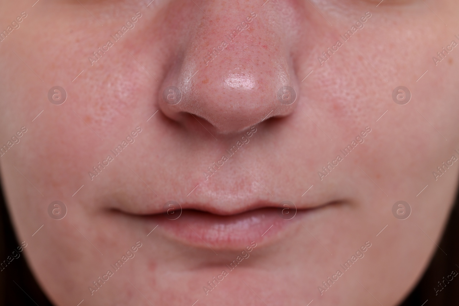 Photo of Closeup view of woman with blackheads on her nose