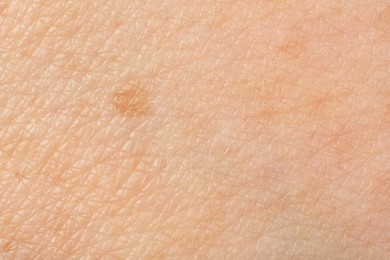 Photo of Texture of skin with pigmentation as background, macro view