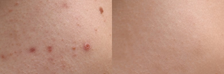 Image of Collage with photos of person suffering from acne before and after treatment, closeup. Banner design showing affected and healthy skin