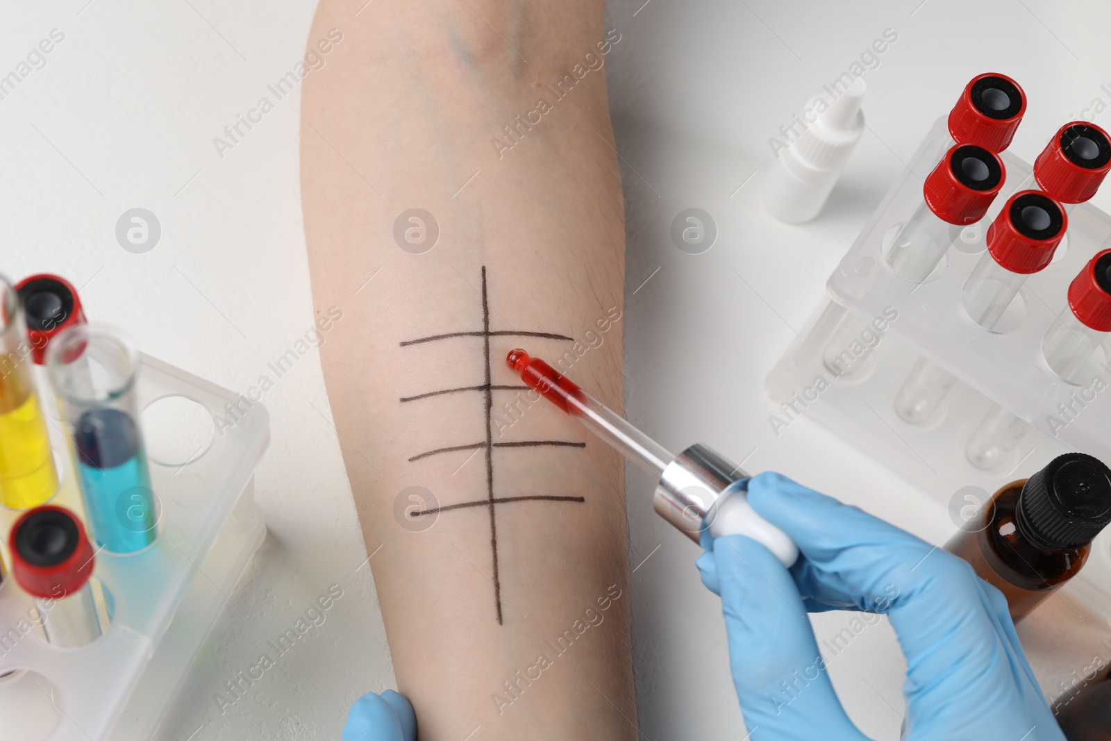 Photo of Doctor doing skin allergy test at light table, above view