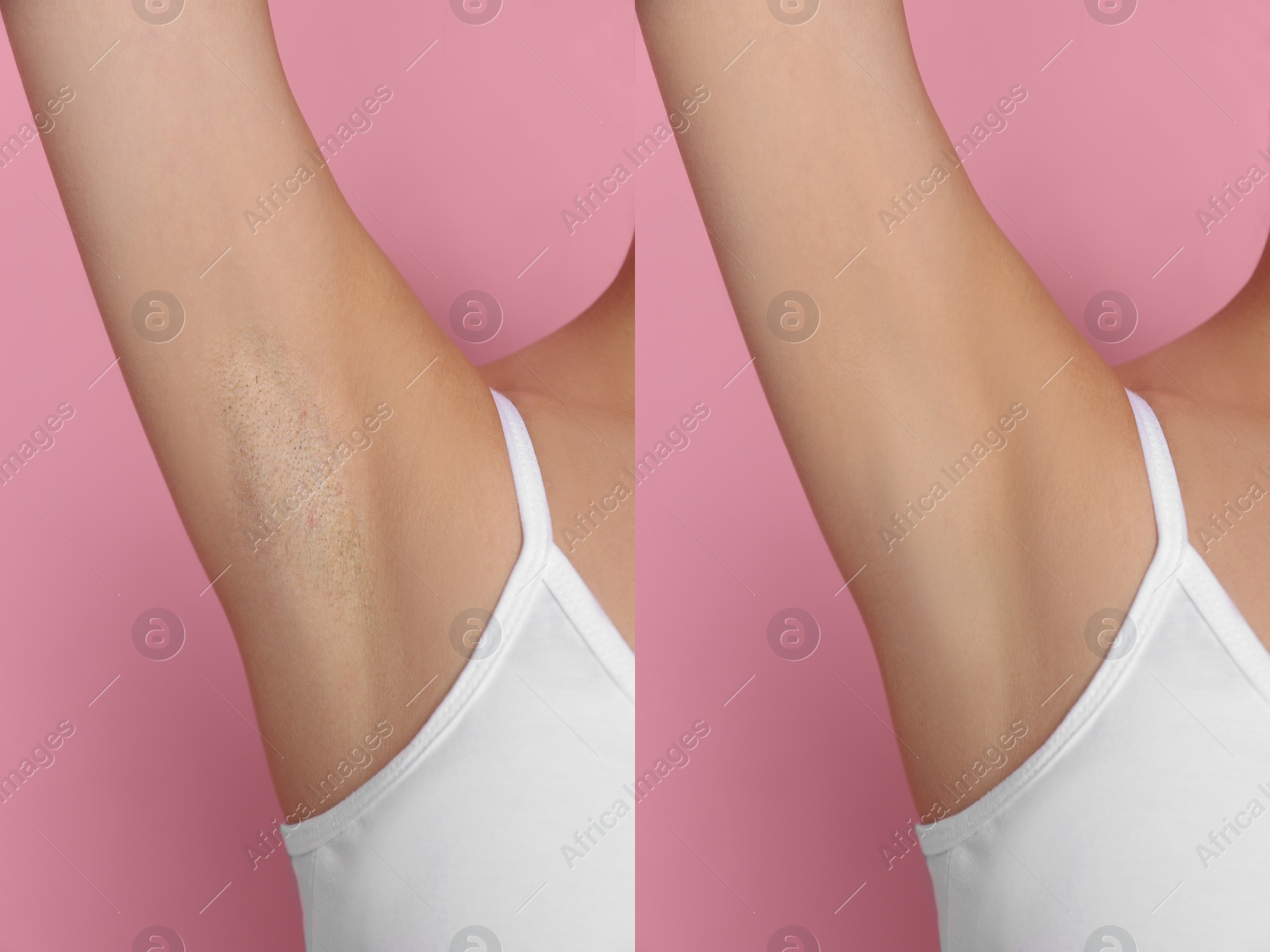 Image of Before and after epilation. Collage with photos of woman showing armpit on pink background, closeup