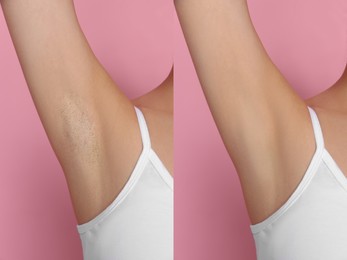 Before and after epilation. Collage with photos of woman showing armpit on pink background, closeup