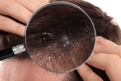 Image of Man suffering from dandruff, closeup. View through magnifying glass on hair with flakes