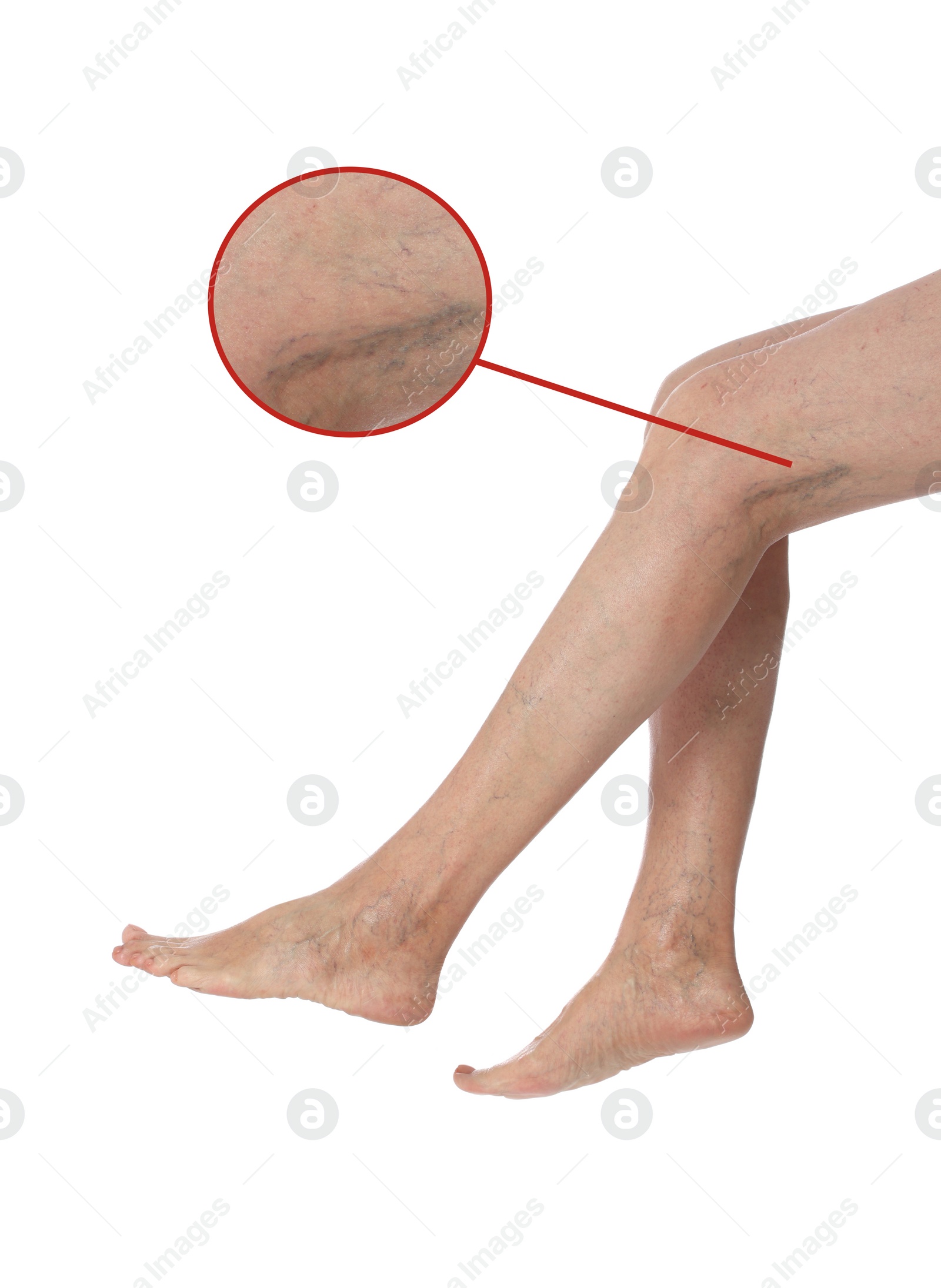 Image of Woman suffering from varicose veins on white background, closeup. Magnified skin surface showing affected area