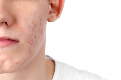 Young man with acne problem isolated on white, closeup