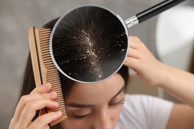 Woman suffering from dandruff on blurred background, closeup. View through magnifying glass on hair with flakes