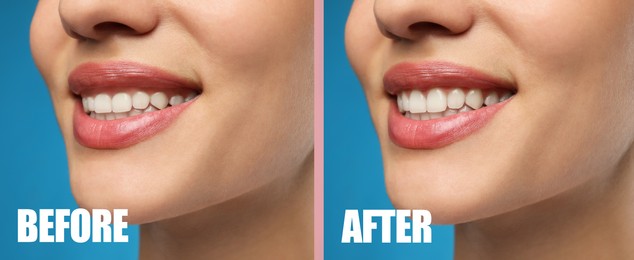 Image of Young woman before and after gingivoplasty procedure on light blue background, closeup. Banner design