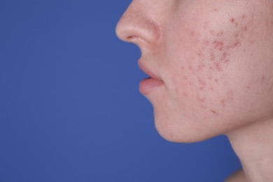 Photo of Young woman with acne problem on blue background, closeup. Space for text