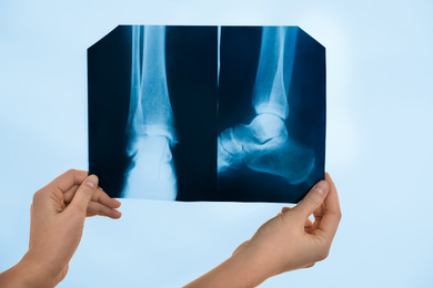 Photo of Orthopedist examining X-ray picture on viewing screen, closeup