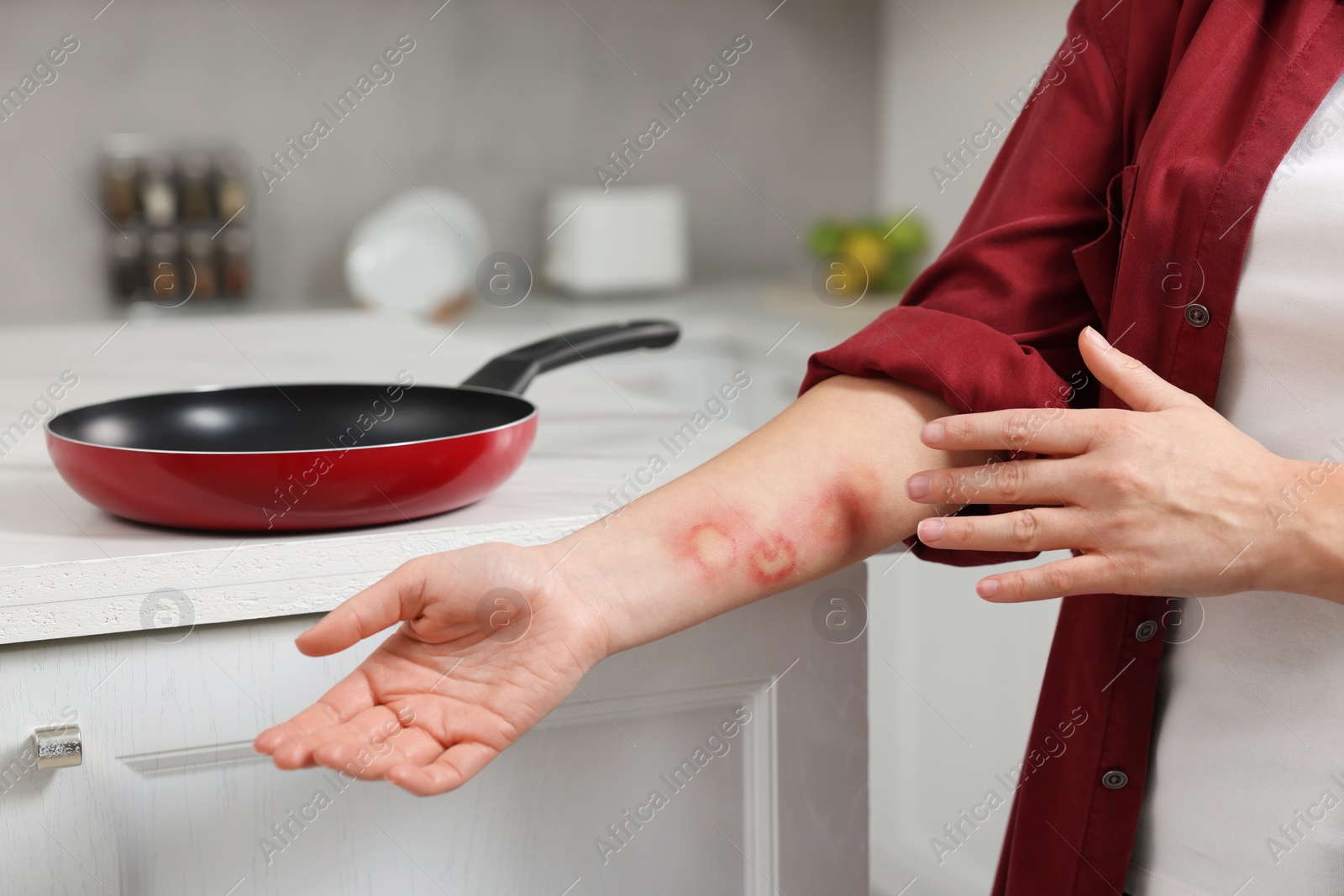 Photo of Woman with burns on her hand in kitchen, closeup