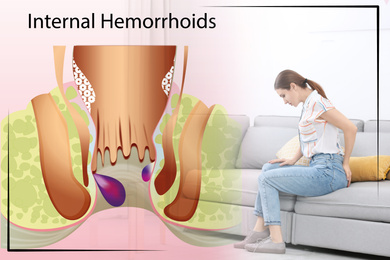 Young woman suffering from hemorrhoid pain on sofa at home. Illustration of unhealthy lower rectum