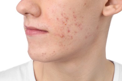 Young man with acne problem isolated on white, closeup