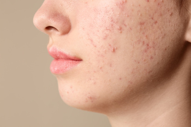 Photo of Teenage girl with acne problem on beige background, closeup