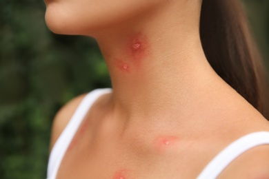 Photo of Woman with insect bites on body outdoors, closeup view