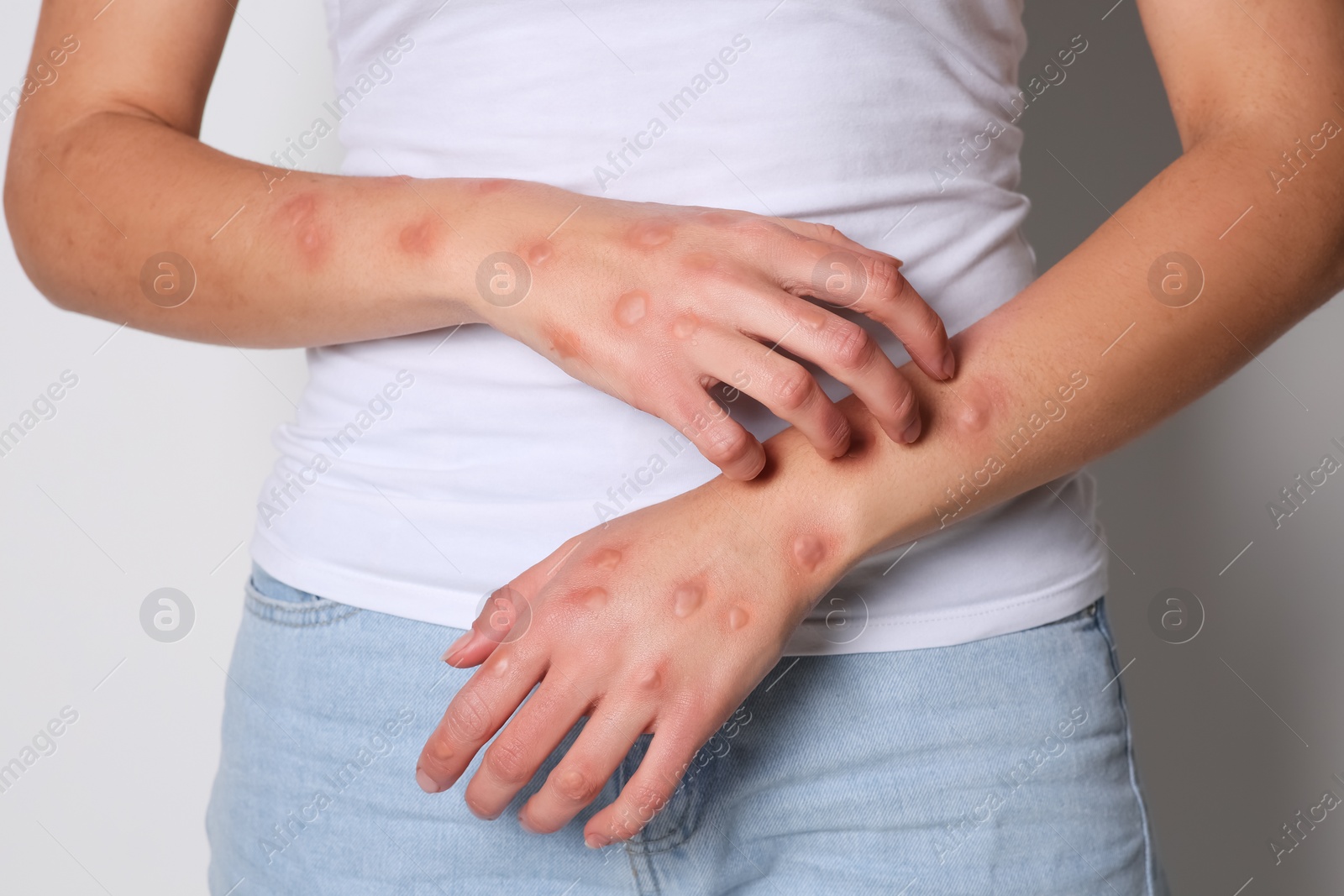 Photo of Woman with rash suffering from monkeypox virus on white background, closeup