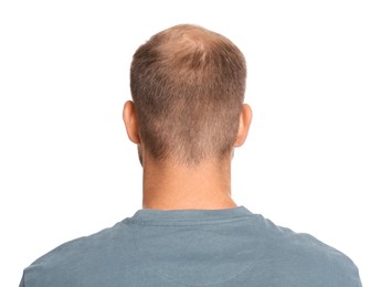 Photo of Man with hair loss problem on white background, back view. Trichology treatment