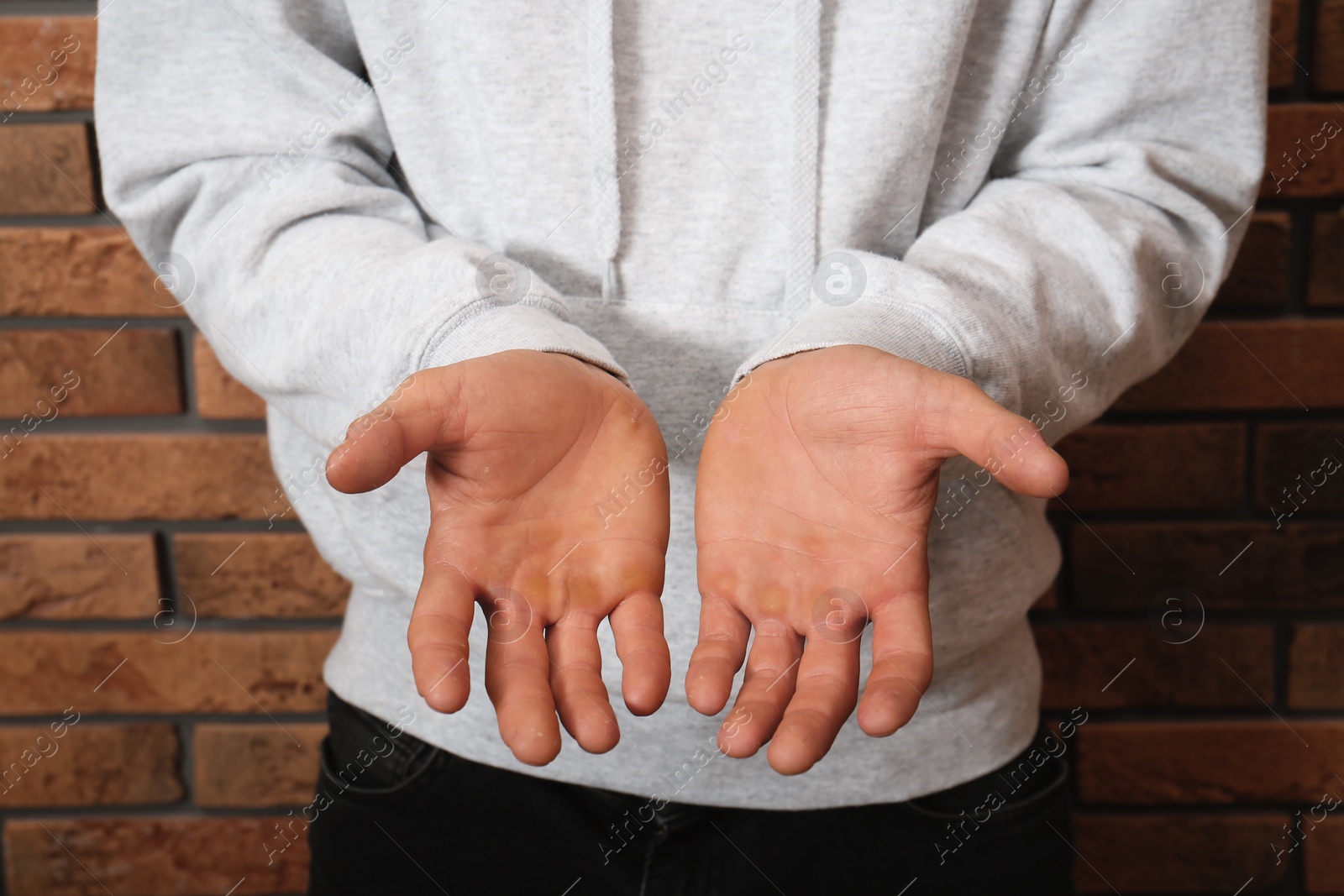 Photo of Man suffering from calluses on hands near brick wall, closeup