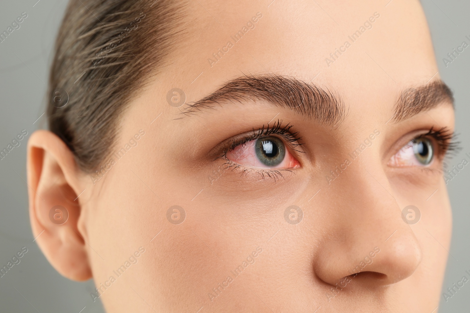 Image of Woman with red eye suffering from conjunctivitis on grey background, closeup