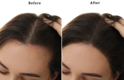 Image of Woman suffering from baldness on white background, closeup. Collage with photos before and after treatment
