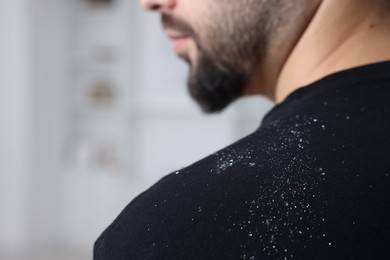 Man with dandruff on his sweater indoors, closeup. Space for text