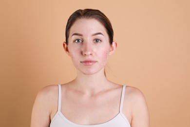 Young woman with acne problem on beige background