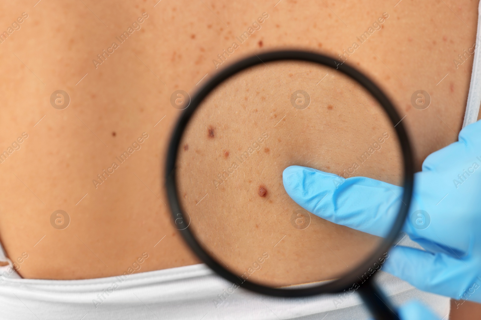 Photo of Dermatologist examining patient's birthmark with magnifying glass, closeup