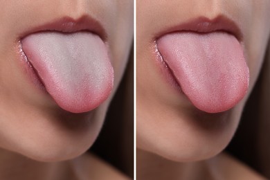 Woman showing her tongue before and after cleaning procedure, closeup. Tongue coated with plaque on one side and healthy on other, collage