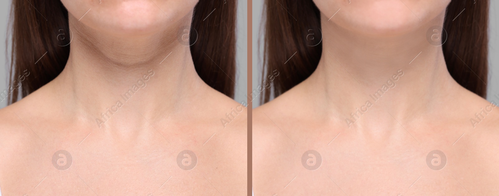 Image of Aging skin changes. Woman showing neck before and after rejuvenation, closeup. Collage comparing skin condition