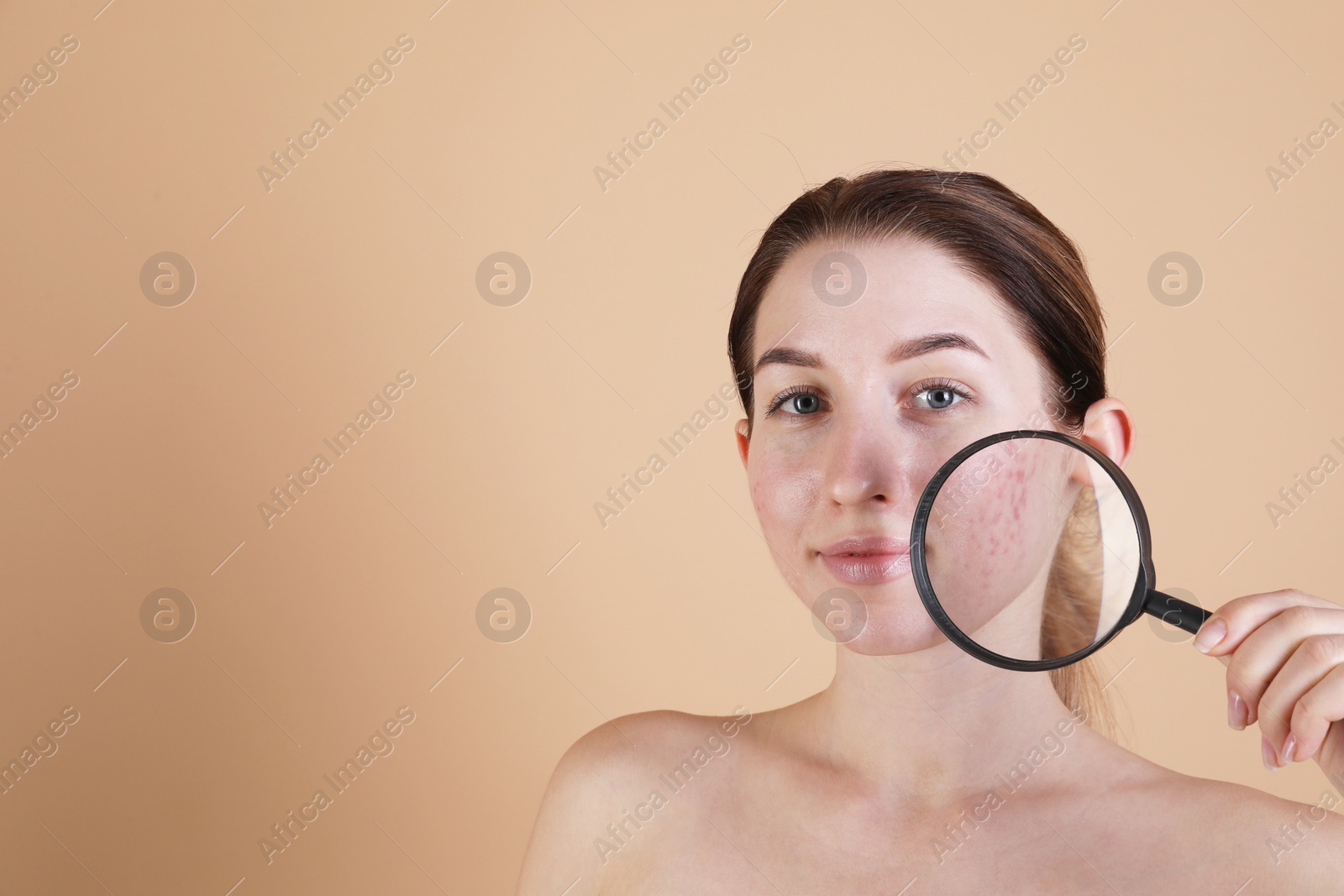 Photo of Young woman with acne problem holding magnifying glass near her skin on beige background. Space for text