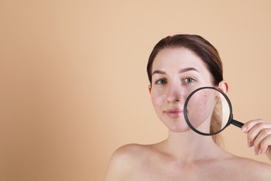 Young woman with acne problem holding magnifying glass near her skin on beige background. Space for text