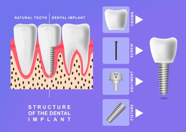 Image of Structure of dental implant on violet background, illustration. Educational poster