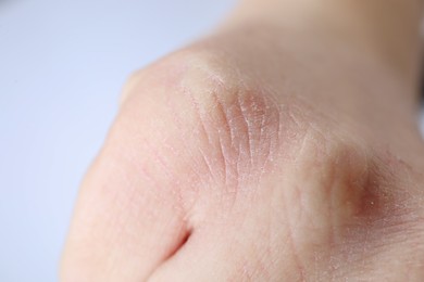 Photo of Woman with dry skin on hand against light background, closeup