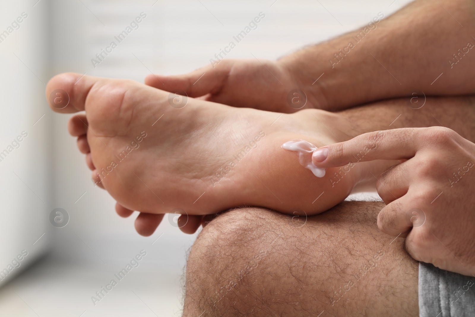 Photo of Man with dry skin applying cream onto his foot on light background, closeup