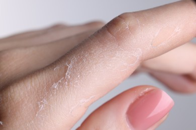 Photo of Woman with dry skin on hand against light background, macro view