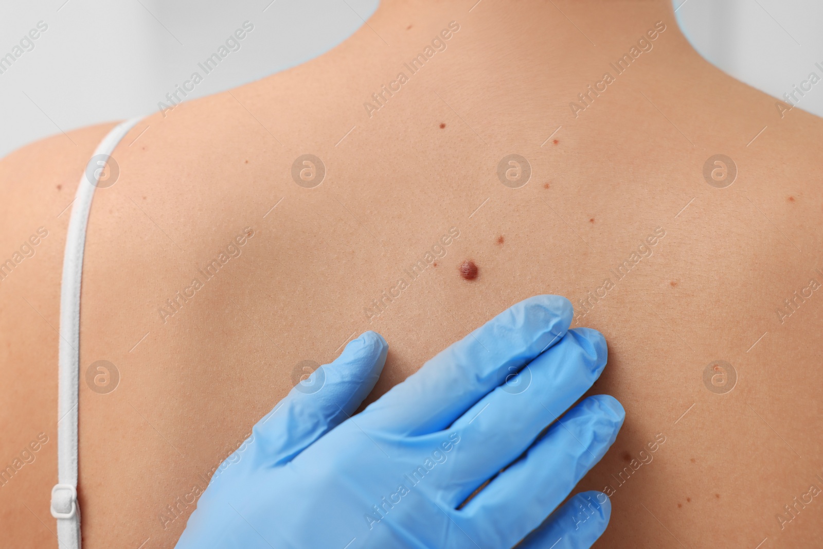 Photo of Dermatologist in rubber glove examining patient's birthmark, closeup view