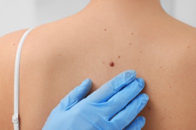 Dermatologist in rubber glove examining patient's birthmark, closeup view