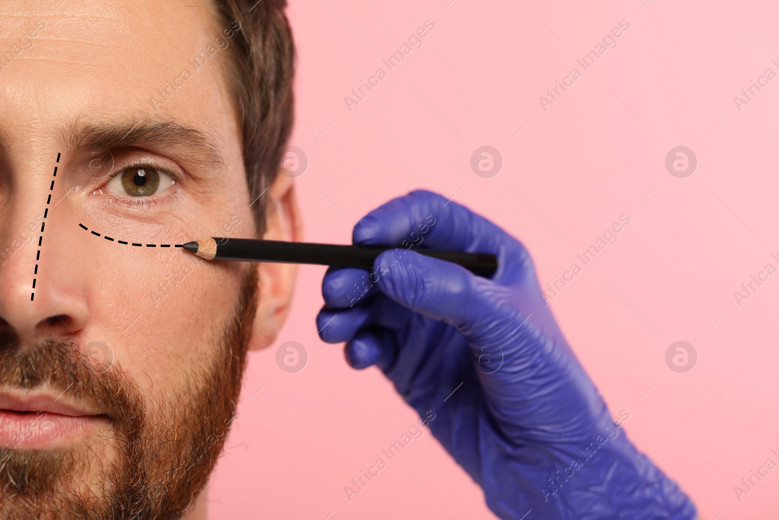 Image of Man preparing for cosmetic surgery, pink background. Doctor drawing markings on his face, closeup