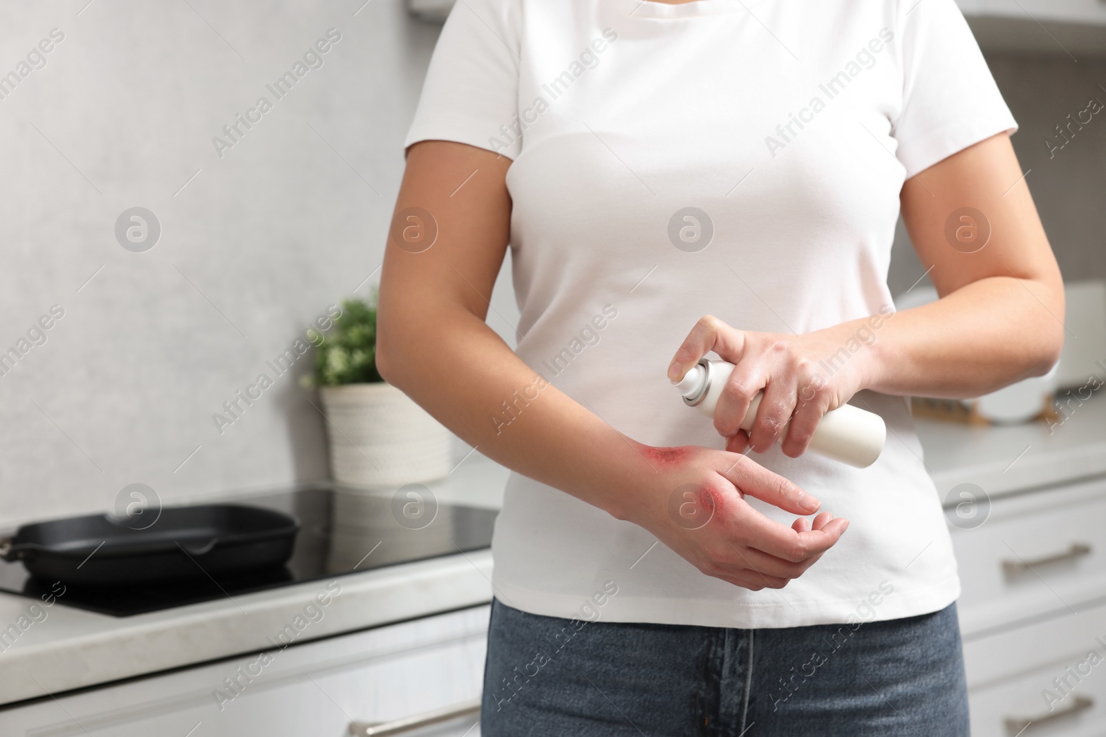 Photo of Woman applying panthenol onto burns on her hand in kitchen, closeup. Space for text